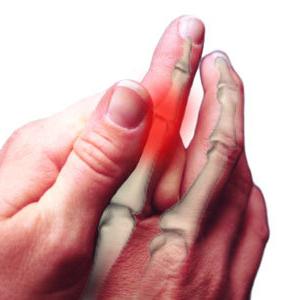 Artritida prstů: léčba, příčiny, příznaky